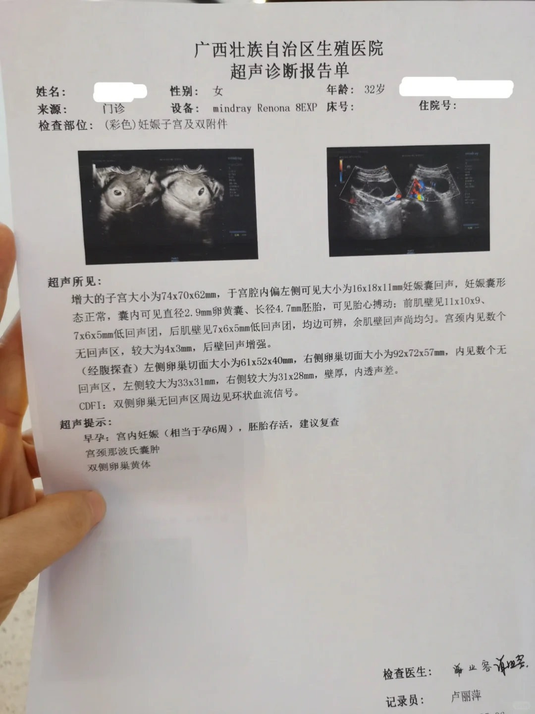 <b>鲜胚移植28天，移植两个，单胎报喜</b>